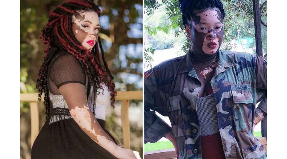 deri-xesteliyi-tapan-qiz-meshhur-model-oldu