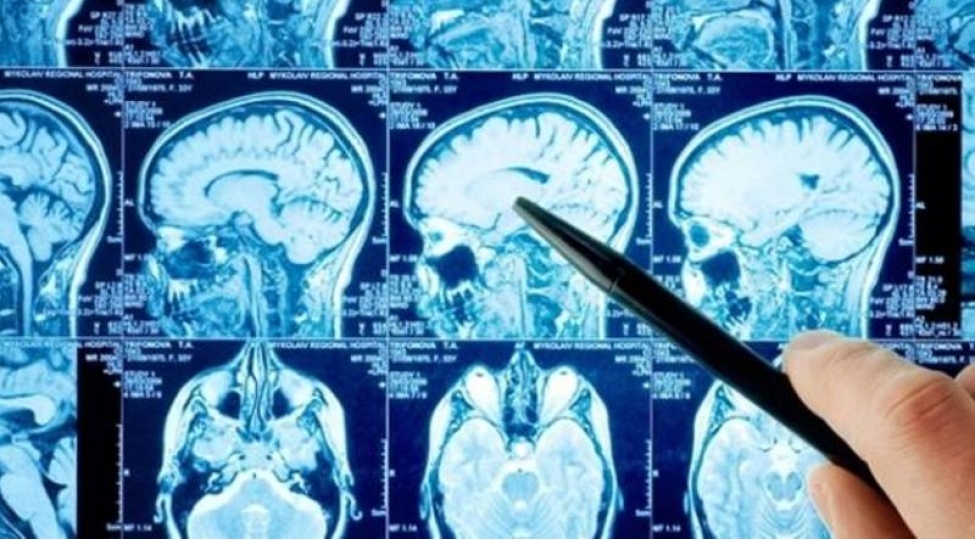 60-il-beyni-olmadan-saglam-yashadi