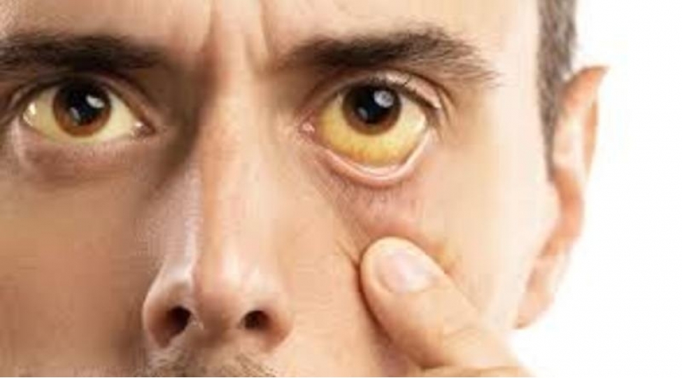 qaraciyerin-toksinlerle-dolu-oldugunu-bildiren-elametler