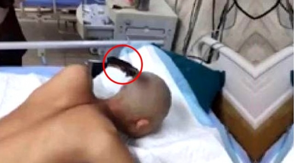 bashina-bichaq-sancilmish-kishi-gorun-ne-etdi