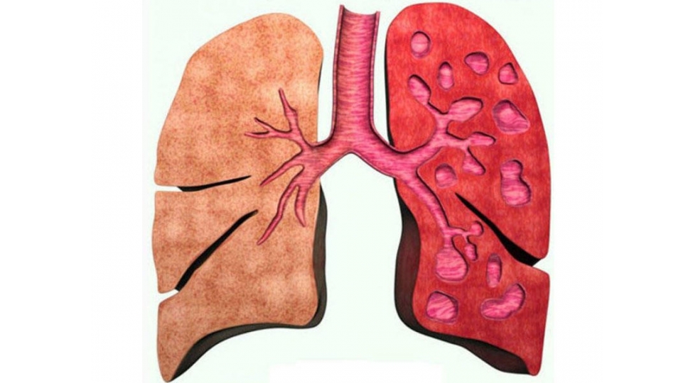 bu-xestelik-qadinlara-nisbeten-kishilerde-daha-genish-yayilib