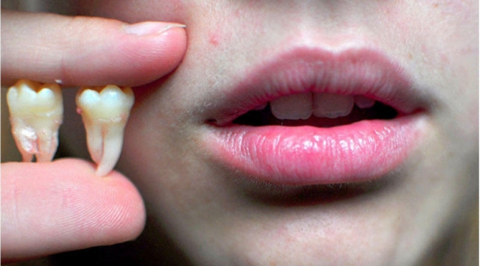 stomatoloq-koronavirus-dishlerin-dagilmasini-suretlendirir