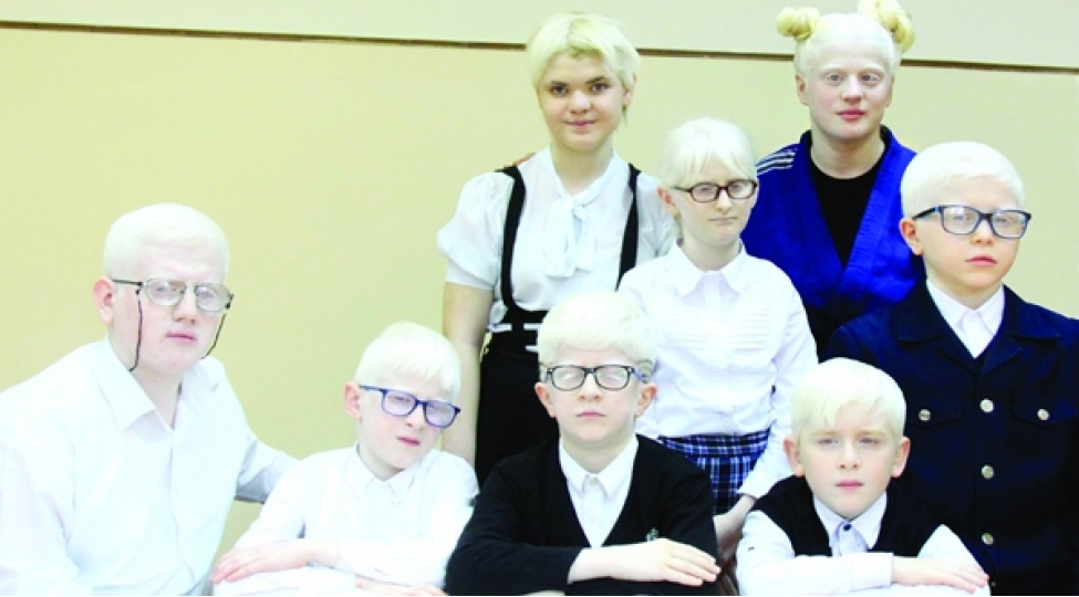 albinos-qolundan-boyunbagi-foto