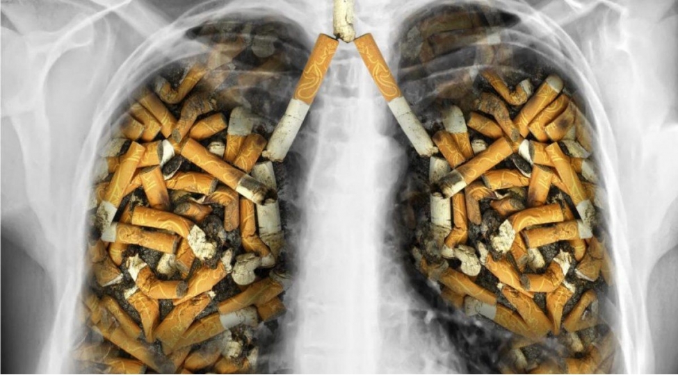 siqaret-chekenlerde-agciyer-xerchengi-olmur