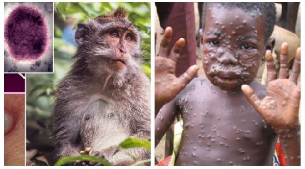 meymunchicheyi-virusu-76-gun-erzinde-foto