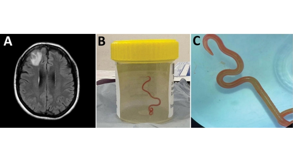 bu-ki-inanilmazdir-xestenin-beyninde-8-santimetrlik-parazit-qurd