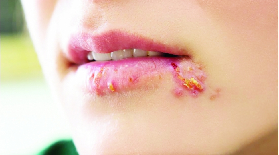 herpes-haqqinda-bilmedikleriniz