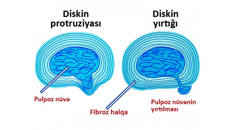 feqerearasi-diskin-protruziyasi-diaqnostika-ve-mualice