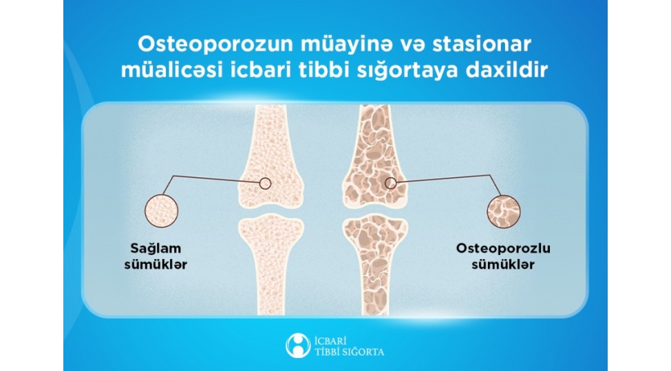 osteoporozun-muayine-ve-stasionar-mualicesi-icbari-tibbi-sigortaya-daxildir
