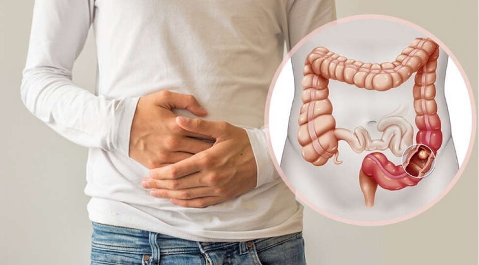 mart-yogun-bagirsaq-xerchengi-ile-mubarize-ayidir